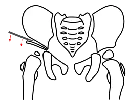 Acetabuloplastik, Schritt 2, Herunterklappen des Pfannenfragmentes