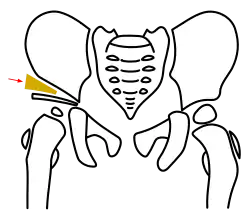 Acetabuloplastik, Schritt 3, Interposition des Knochenkeils