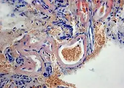 Anfärbung von Amyloid in der Wand meningealer Blutgefäße bei der zere­bralen Amyloidangiopathie