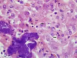 Leberpräparat einer Boa constrictor mit BIBD (HE, 1000fache Vergrößerung). Eosinophile EK in Leberzellen (ausgewählte EK mit Pfeilen markiert). Zusätzliche bakterielle Infiltration mit akuter Leberzellnekrose (dunkel gefärbte Bereiche unten links).