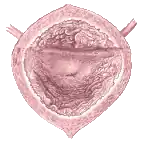 Links: Schematische Darstellung der anatomischen Verhältnisse zwischen Harnblase und Harnröhre, Rechts: Blick aus dem Inneren der Harnblase, dem Trigonum vesicae und als dem Ursprungsort der Urethra die zentral liegende Öffnung der inneren Harnröhrenmündung (Ostium urethrae internum)
