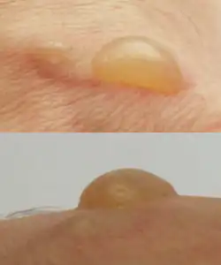 Brandblase nach 12 Stunden