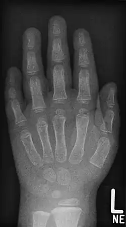 Junge, 3,5 Jahre. Beachte auch die Brachymesophalangie am Kleinfinger