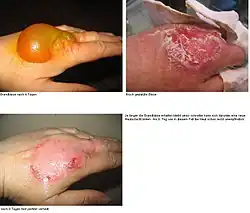 Stadien der Brandblasen