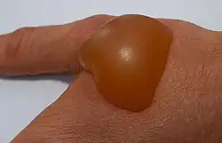 Große Brandblase auf Handrücken