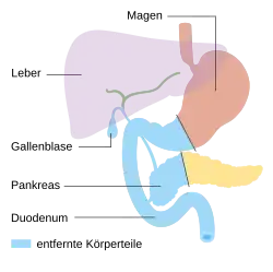 Duodenopankreat­ektomie nach Whipple