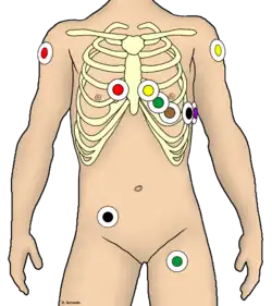EKG-Ableitung unter Rettungsdienst-Bedingungen
