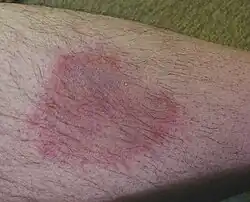 Wanderröte als Folge eines Zeckenstichs mit Borrelioseinfektion