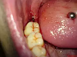 Wunde eines frisch extrahierten Weisheitszahns, Nebenbefund: Zungenpiercing