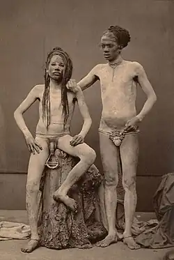 Fakire in Indien mit großem Schmuckstück durch Ampallang, zw. 1870–1880 (links), Dayak mit Ampallang (1920) (rechts)