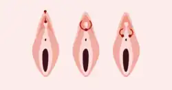 Darstellung verschiedener Piercings durch die Klitorisvorhaut oder in deren unmittelbaren Umgebung: Vertikales (links) und horizontales Klitorisvorhautpiercing (Mitte), Triangle-Piercing (rechts)