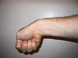 Moderne Durchführung des Finkelstein-Tests (ursprünglicher Eichhoff-Test)