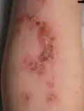 Eingetrocknete Impetigoblasen