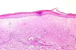 Histologie eines atrophen Lichen sclerosus.