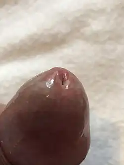 Lichen sclerosus genitalis der Eichel