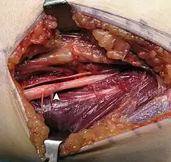 Das Operationsgebiet nach der Exzision des Lipoms. Die Pfeile zeigen auf die Deformation des Nervus medianus durch das Lipom, die zu einer Parästhesie bei dem 46-Jahre alten männlichen Patienten führte.[15]