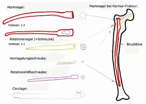 Marknagel im Oberschenkelknochen