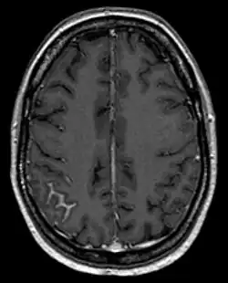 Bildgebung: Nachweis einer fokalen Meningeosis carcinomatosa bei Mammakarzinom in der Magnetresonanztomographie. Man erkennt die fokale Anreicherung (hell) in den Sulci als Zeichen einer arachnoidalen Ausbreitung rechts (links im Bild).