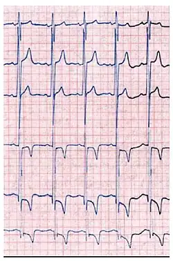 Das EKG eines Morbus-Fabry-Patienten zeigt eine linksventrikuläre Hypertrophie mit erhöhtem Sokolow-Lyon-Index, reduzierter ST-Strecke und negativen T-Wellen in den linken EKG-Ableitungen.