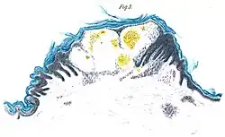 Zeichnung nach einer Mikroskopbetrachtung einer Carminfärbung der Epidermis mit einem Angiokeratom, Aquarell aus Johannes Fabrys Artikel von 1898
