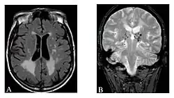Hyperintensitäten der weißen Hirnsubstanz, lakunare Hirninfarkte und Mikroblutungen. A) Die axiale MRT zeigt vielfältige Läsionen der weißen Hirnsubstanz in der zerebralen Hemisphäre eines 53-jährigen männlichen Patienten mit einem Fazekas-Score von 3. B) Lakune und Mikroblutungen bei demselben Patienten.