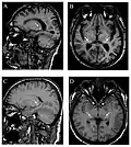 Die T1-gewichteten sagittalen (A) und axialen (B) MRTs zeigen ein symmetrisch hohes Signal im Thalamus (das sogenannte Pulvinar Sign) eines 66-jährigen männlichen Patienten. (C) und (D), ebenfalls T1-gewichtet, zeigen das Pulvinar Sign bei einem 42-jährigen Patienten.