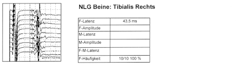 Normale F-Wellen des N. tibialis