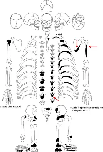 Das erhaltene Skelettmaterial (schwarz) mit Hervorhebungen der Stichverletzungen