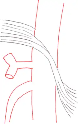Schematische Darstellung: links der anatomische Normalbefund, das Ligamentum arcuatum medianum liegt oberhalb des Abganges der Arteria coeliaca; rechts gut zu erkennen, wie das Ligamentum das Gefäß einschnürt.