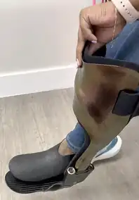 Anlegen des Orthesenanteils der Orthoprothese