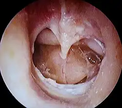 Perforiertes Trommelfell