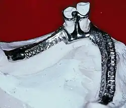 Eine Modellgussbasis auf dem Arbeitsmodell