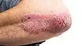 Psoriasis, klinisch