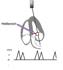 Schema der Messung mittels PW-Doppler an der Mitralklappe