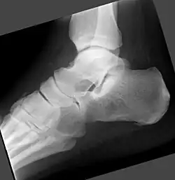 Vorhandenes Knochenmarködem nicht erkennbar