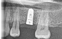 Röntgenbild eines Zahnimplantates in Regio 26 unmittelbar nach internem Sinuslift