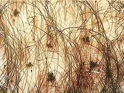 Filzlausbefall im Schamhaar