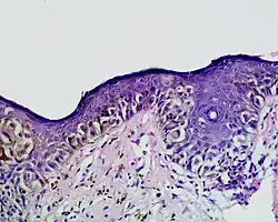 Kettenartig aneinandergereihte atypische Melanozyten