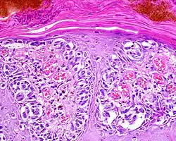 Große Tumorzellen mit vielgestaltigen Zellkernen