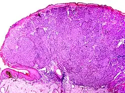 Noduläres Melanom: halbkugelig vorgewölbter Tumor