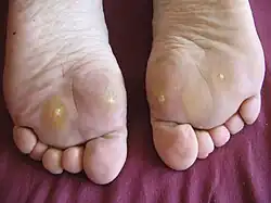 Schmerzhafte Dornwarzen an den Ballen