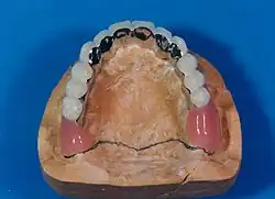 Prothese über der Stegkonstruktion eingesetzt