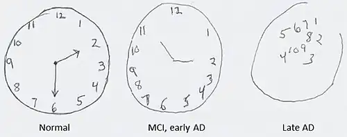 Links: Uhrenzeichnung einer gesunden Kontrollperson Mitte: Betroffene in der Frühphase. Die Grundstruktur der Uhr ist noch zu erkennen, die Stunden jedoch nicht mehr gleichmäßig verteilt. Rechts: Verworrenes Bild, der äußere Ring der Uhr ist nicht mehr geschlossen, die Zahlen wahllos in der Mitte des Ziffernblatts positioniert.