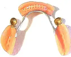 Unterkiefer-Teleskopprothese – mit zwei Teleskopen und drei Prothesensätteln