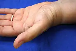 Muskelschwund am Daumenballen bei fortgeschrittenem Karpaltunnelsyndrom