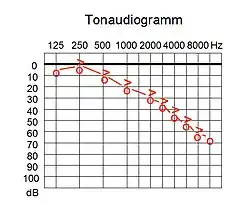 Tonaudiogramm, Schallempfindungsstörung