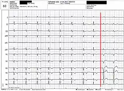 unauffälliges Ruhe-EKG mit einsetzendem Linksschenkelblock