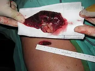 Per Lobektomie entfernter Lungentumor im Größenvergleich zum Eingriffskanal (Durchmesser 3,7&nbsp;cm).