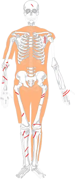 Moorleiche Frau von Zweeloo